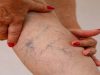 Cold Feet and Heavy Legs Could Be a Sign of Varicose Veins, Says Study