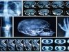 New Machine Algorithm Can Detect Heart and Fracture Risks Through Routine Bone Scans