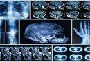 New Machine Algorithm Can Detect Heart and Fracture Risks Through Routine Bone Scans