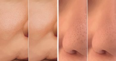 Combined Botox and Hyaluronic Acid Shrinks Acne Pores