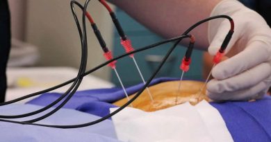 Radiofrequency Ablation Offers Relief for Chronic Pain